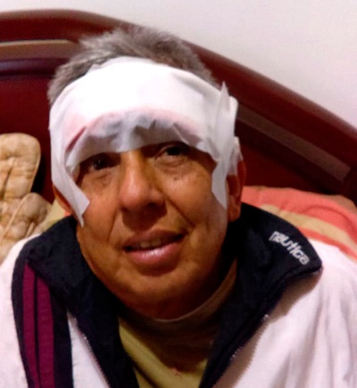 Con novedosa cirugía de Mohs, médicos extirpan cáncer de piel en la frente de paciente